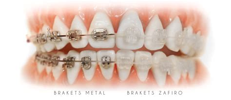 metalicos brackets de zafiro|brackets de zafiro metal.